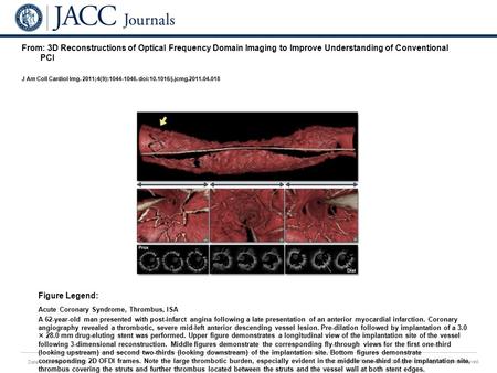 Date of download: 6/1/2016 Copyright © The American College of Cardiology. All rights reserved. From: 3D Reconstructions of Optical Frequency Domain Imaging.