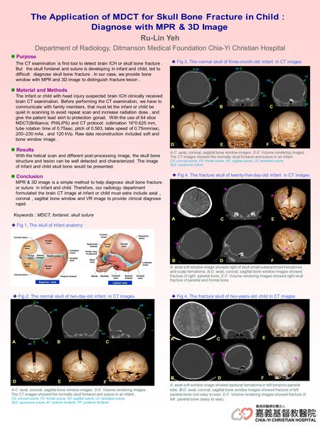 Purpose The CT examination is first tool to detect brain ICH or skull bone fracture. But the skull fontanel and suture is developing in infant and child,