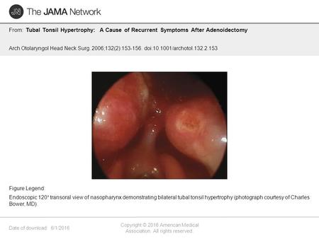 Date of download: 6/1/2016 Copyright © 2016 American Medical Association. All rights reserved. From: Tubal Tonsil Hypertrophy: A Cause of Recurrent Symptoms.