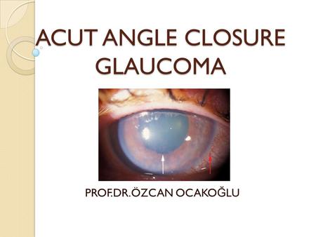 ACUT ANGLE CLOSURE GLAUCOMA