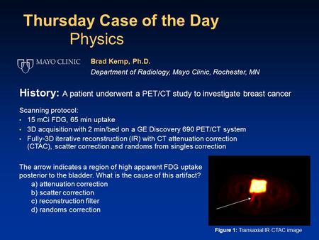 Thursday Case of the Day The arrow indicates a region of high apparent FDG uptake posterior to the bladder. What is the cause of this artifact? a) attenuation.