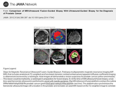 Date of download: 6/2/2016 Copyright © 2016 American Medical Association. All rights reserved. From: Comparison of MR/Ultrasound Fusion–Guided Biopsy With.