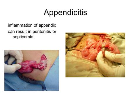 Appendicitis inflammation of appendix can result in peritonitis or septicemia.