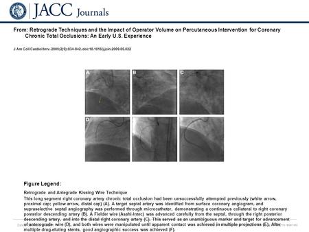 Date of download: 6/2/2016 Copyright © The American College of Cardiology. All rights reserved. From: Retrograde Techniques and the Impact of Operator.