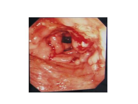 Colonoscopy: rectum, sigmoid, left colon, transverse colon were normal – in the right colon and caecum: pseudopolyps, friability, edema, deformation (