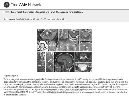 Date of download: 6/6/2016 Copyright © 2016 American Medical Association. All rights reserved. From: Superficial Siderosis: Associations and Therapeutic.