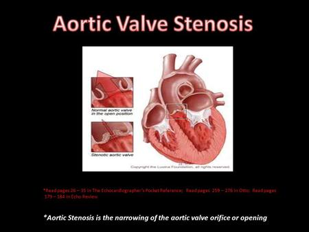 *Aortic Stenosis is the narrowing of the aortic valve orifice or opening *Read pages 26 – 35 in The Echocardiographer’s Pocket Reference; Read pages 259.