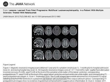 Date of download: 6/6/2016 Copyright © 2016 American Medical Association. All rights reserved. From: Lessons Learned From Fatal Progressive Multifocal.