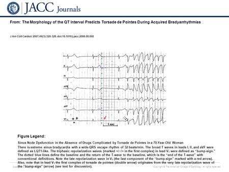 Date of download: 6/17/2016 Copyright © The American College of Cardiology. All rights reserved. From: The Morphology of the QT Interval Predicts Torsade.