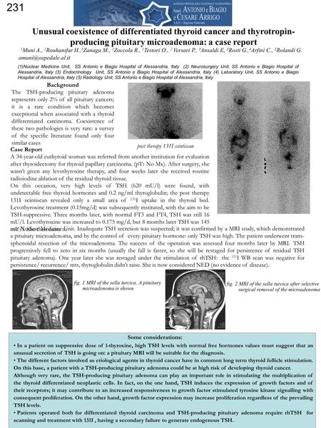 231 Unusual coexistence of differentiated thyroid cancer and thyrotropin- producing pituitary microadenoma: a case report 1 Muni A., 1 Rouhanifar H., 1.