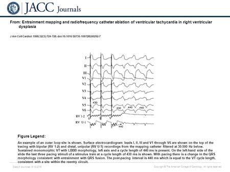 Date of download: 6/18/2016 Copyright © The American College of Cardiology. All rights reserved. From: Entrainment mapping and radiofrequency catheter.