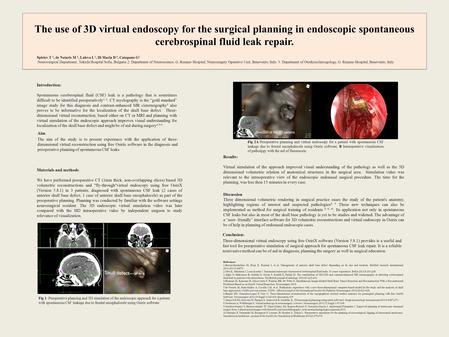 The use of 3D virtual endoscopy for the surgical planning in endoscopic spontaneous cerebrospinal fluid leak repair. Conclusion: Three-dimensional virtual.