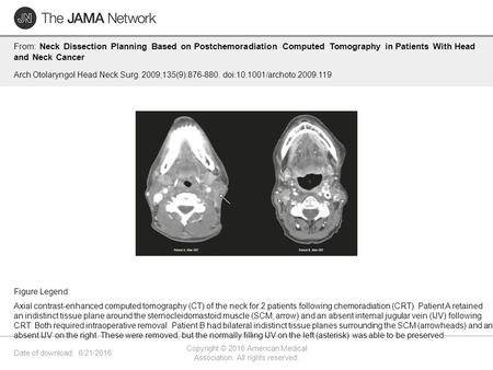 Date of download: 6/21/2016 Copyright © 2016 American Medical Association. All rights reserved. From: Neck Dissection Planning Based on Postchemoradiation.