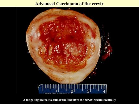 Advanced Carcinoma of the cervix