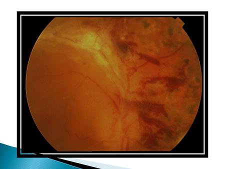 Old Fibrotic Vascular tissue in End-Stage Proliferative Retinopathy