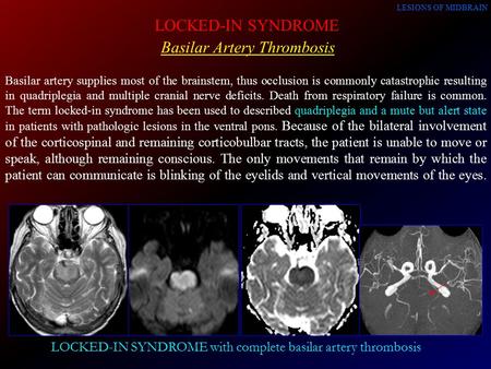 Basilar Artery Thrombosis