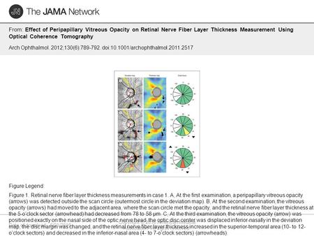 Date of download: 6/21/2016 Copyright © 2016 American Medical Association. All rights reserved. From: Effect of Peripapillary Vitreous Opacity on Retinal.