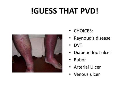 !GUESS THAT PVD! CHOICES: Raynoud’s disease DVT Diabetic foot ulcer