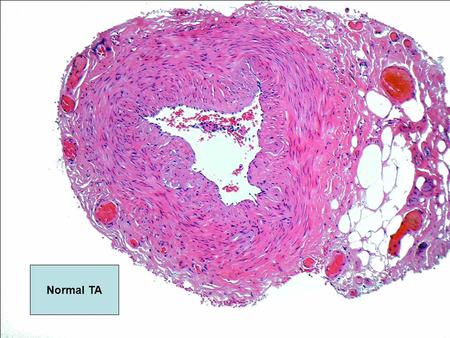 Normal TA. intima media adventitia Bluish curly line is internal elastic lamina.