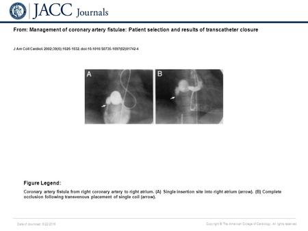 Date of download: 6/22/2016 Copyright © The American College of Cardiology. All rights reserved. From: Management of coronary artery fistulae: Patient.