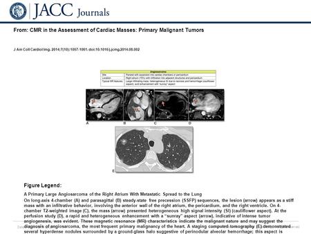 Date of download: 6/22/2016 Copyright © The American College of Cardiology. All rights reserved. From: CMR in the Assessment of Cardiac Masses: Primary.