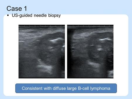 Case 1  US-guided needle biopsy Consistent with diffuse large B-cell lymphoma.