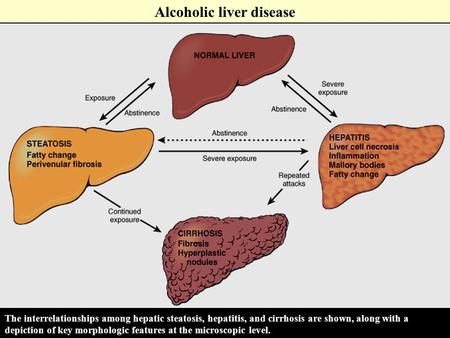 Alcoholic liver disease