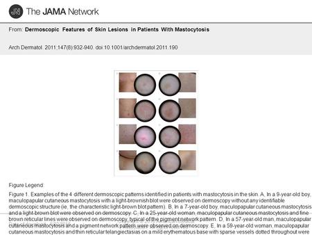 Date of download: 6/22/2016 Copyright © 2016 American Medical Association. All rights reserved. From: Dermoscopic Features of Skin Lesions in Patients.