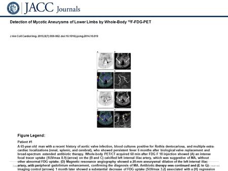 Date of download: 6/23/2016 Copyright © The American College of Cardiology. All rights reserved. Detection of Mycotic Aneurysms of Lower Limbs by Whole-Body.