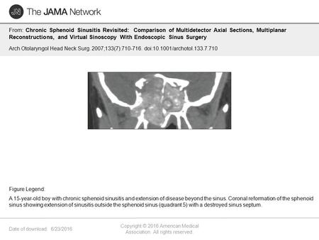 Date of download: 6/23/2016 Copyright © 2016 American Medical Association. All rights reserved. From: Chronic Sphenoid Sinusitis Revisited: Comparison.