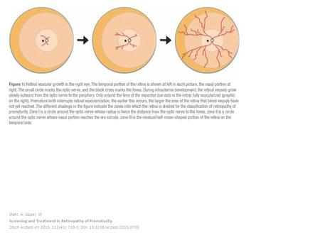 Stahl, A; Göpel, W Screening and Treatment in Retinopathy of Prematurity Dtsch Arztebl Int 2015; 112(43): 730-5; DOI: 10.3238/arztebl.2015.0730.