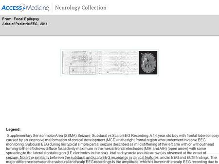 Date of download: 6/23/2016 Copyright © 2016 McGraw-Hill Education. All rights reserved. Supplementary Sensorimotor Area (SSMA) Seizure; Subdural vs Scalp.