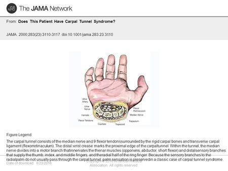 Date of download: 6/23/2016 Copyright © 2016 American Medical Association. All rights reserved. From: Does This Patient Have Carpal Tunnel Syndrome? JAMA.