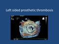 Left sided prosthetic thrombosis. Epidemiology Obstruction of prosthetic heart valves may be caused by thrombus formation, pannus ingrowth, or a combination.