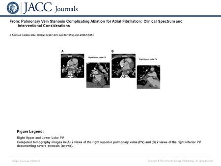 Date of download: 6/25/2016 Copyright © The American College of Cardiology. All rights reserved. From: Pulmonary Vein Stenosis Complicating Ablation for.