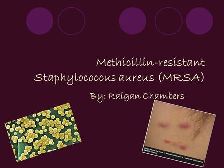 Methicillin-resistant Staphylococcus aureus (MRSA) By: Raigan Chambers.