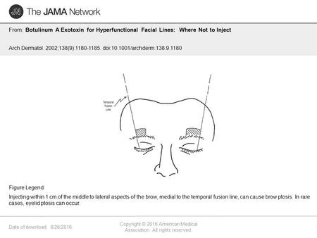 Date of download: 6/26/2016 Copyright © 2016 American Medical Association. All rights reserved. From: Botulinum A Exotoxin for Hyperfunctional Facial Lines: