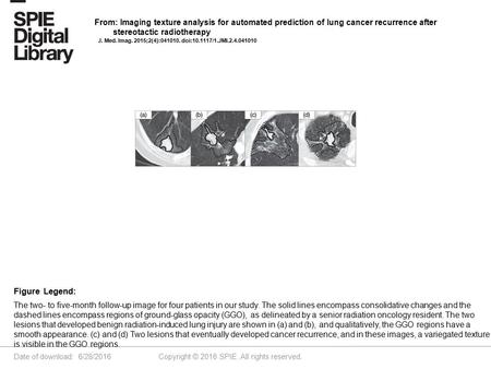 Date of download: 6/28/2016 Copyright © 2016 SPIE. All rights reserved. The two- to five-month follow-up image for four patients in our study. The solid.