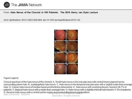 Date of download: 6/28/2016 Copyright © 2016 American Medical Association. All rights reserved. From: Halo Nevus of the Choroid in 150 Patients: The 2010.