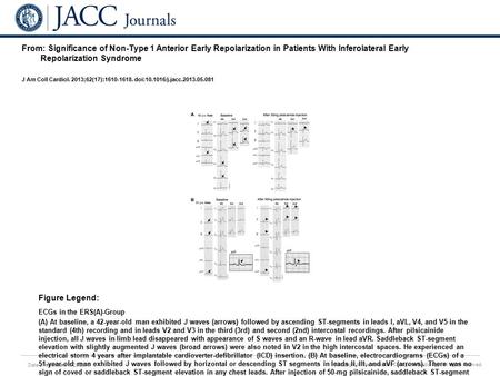 Date of download: 6/28/2016 Copyright © The American College of Cardiology. All rights reserved. From: Significance of Non-Type 1 Anterior Early Repolarization.