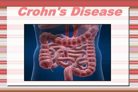 Crohn's Disease. Crohn'sDisease Crohn's Disease What is it? What is it? What are the causes? What are the causes? What are the treatment options? What.