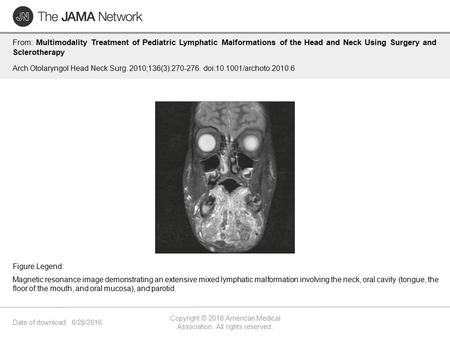 Date of download: 6/28/2016 Copyright © 2016 American Medical Association. All rights reserved. From: Multimodality Treatment of Pediatric Lymphatic Malformations.