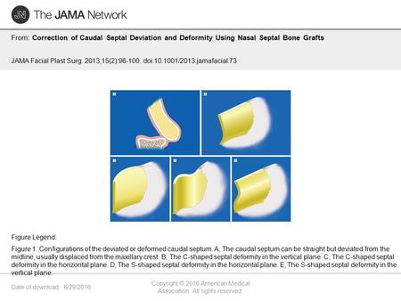 Date of download: 6/29/2016 Copyright © 2016 American Medical Association. All rights reserved. From: Correction of Caudal Septal Deviation and Deformity.