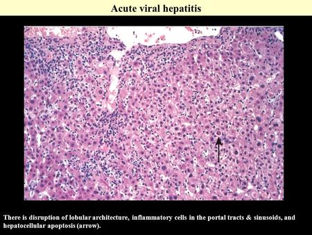 Acute viral hepatitis There is disruption of lobular architecture, inflammatory cells in the portal tracts & sinusoids, and hepatocellular apoptosis (arrow).