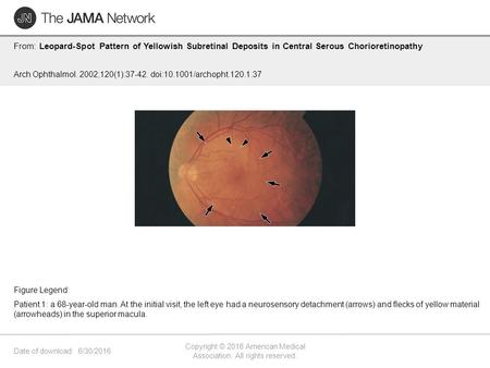 Date of download: 6/30/2016 Copyright © 2016 American Medical Association. All rights reserved. From: Leopard-Spot Pattern of Yellowish Subretinal Deposits.