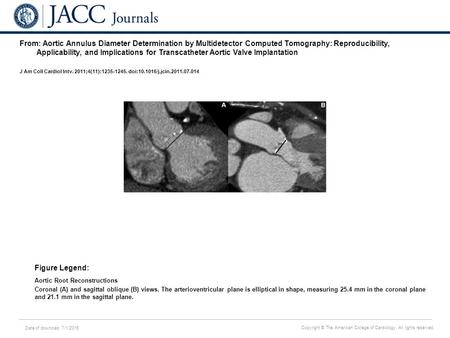 Date of download: 7/1/2016 Copyright © The American College of Cardiology. All rights reserved. From: Aortic Annulus Diameter Determination by Multidetector.