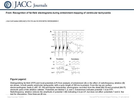 Date of download: 7/2/2016 Copyright © The American College of Cardiology. All rights reserved. From: Recognition of far-field electrograms during entrainment.