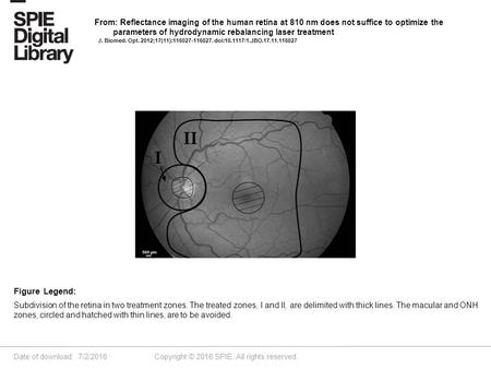 Date of download: 7/2/2016 Copyright © 2016 SPIE. All rights reserved. Subdivision of the retina in two treatment zones. The treated zones, I and II, are.