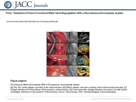 Date of download: 7/2/2016 Copyright © The American College of Cardiology. All rights reserved. From: Treatment of Chronic Functional Mitral Valve Regurgitation.