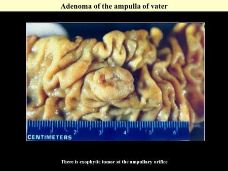 Adenoma of the ampulla of vater